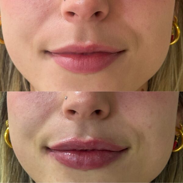 Aumento de labios - Imagen 2