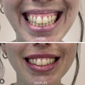 Aumento de labios